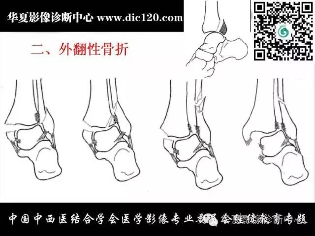 【PPT】踝关节外伤及先天性病变的影像诊断