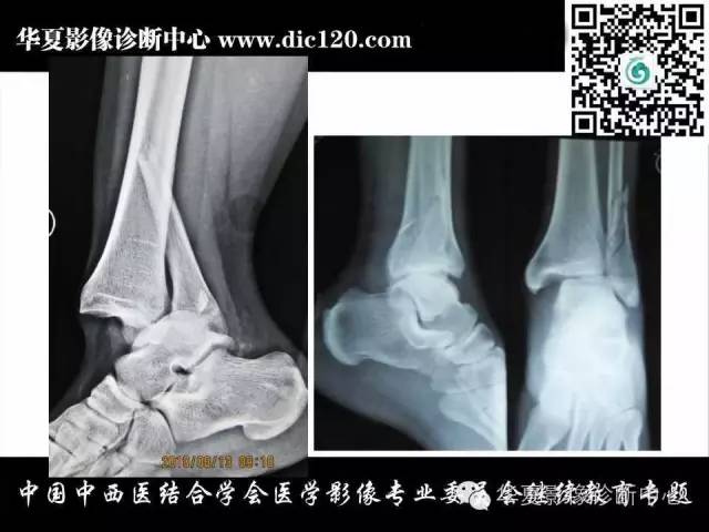 【PPT】踝关节外伤及先天性病变的影像诊断