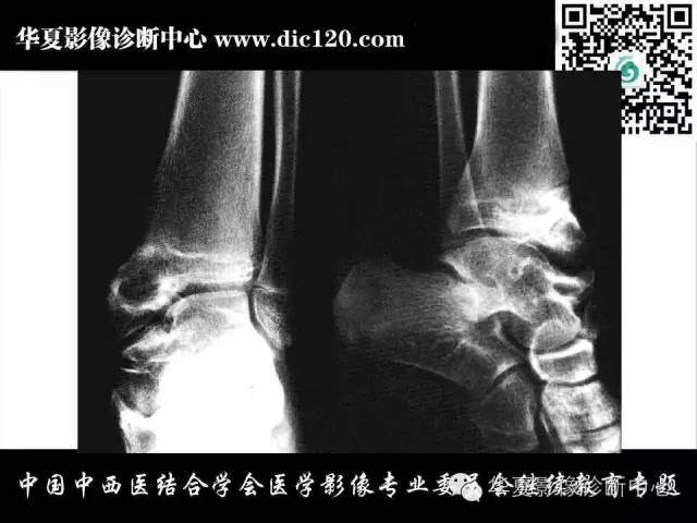 【PPT】踝关节外伤及先天性病变的影像诊断