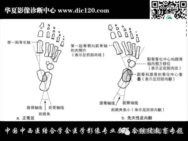 【PPT】踝关节外伤及先天性病变的影像诊断