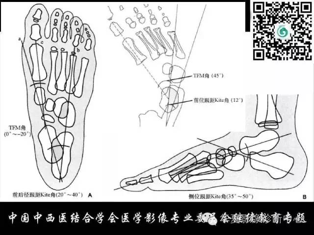 【PPT】踝关节外伤及先天性病变的影像诊断