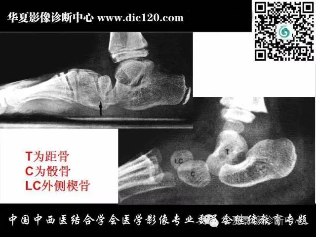 【PPT】踝关节外伤及先天性病变的影像诊断