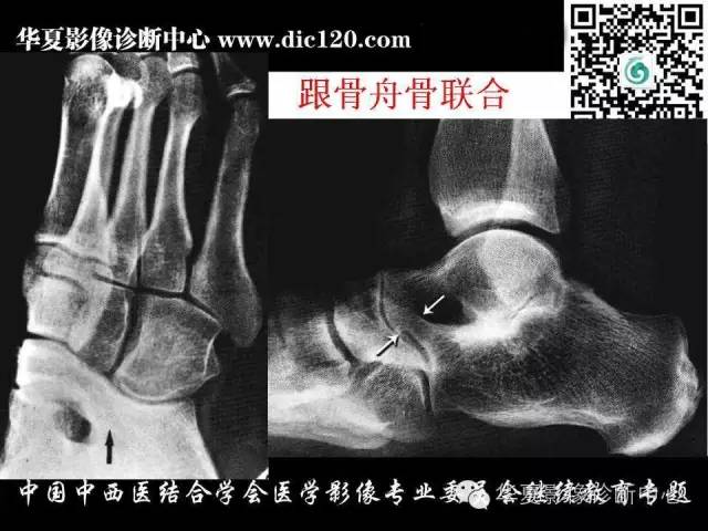 【PPT】踝关节外伤及先天性病变的影像诊断