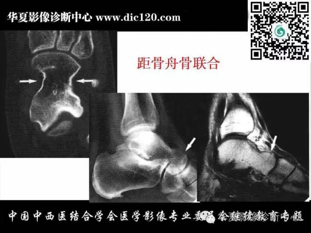 【PPT】踝关节外伤及先天性病变的影像诊断