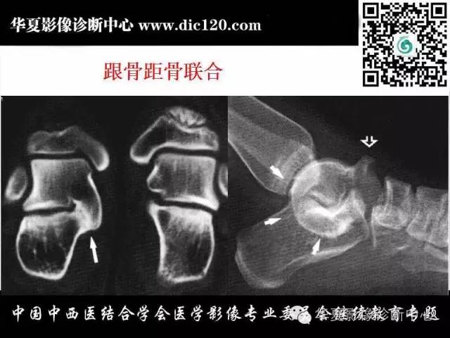 【PPT】踝关节外伤及先天性病变的影像诊断