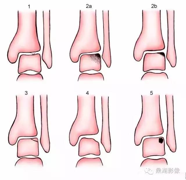 软骨损伤分期