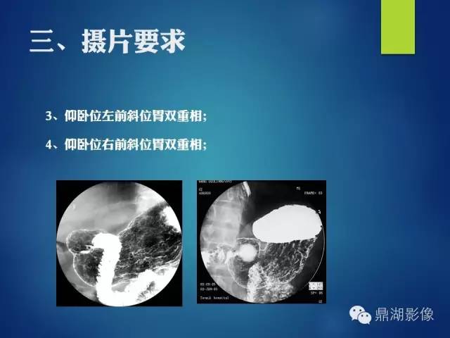 【PPT】上消化道钡剂造影摄片标准