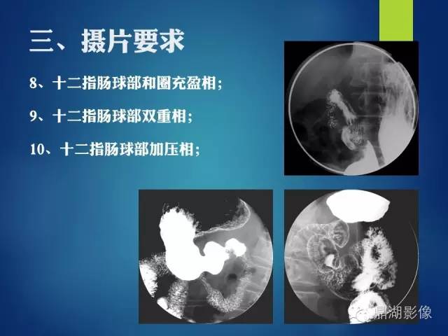 【PPT】上消化道钡剂造影摄片标准