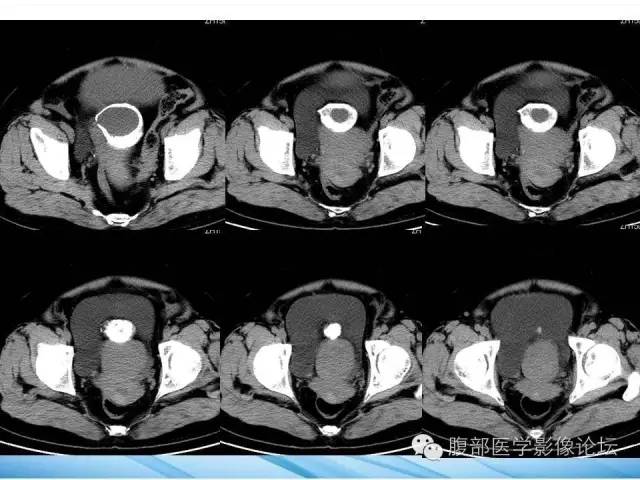 【病例】卵巢透明细胞腺癌1例CT影像表现