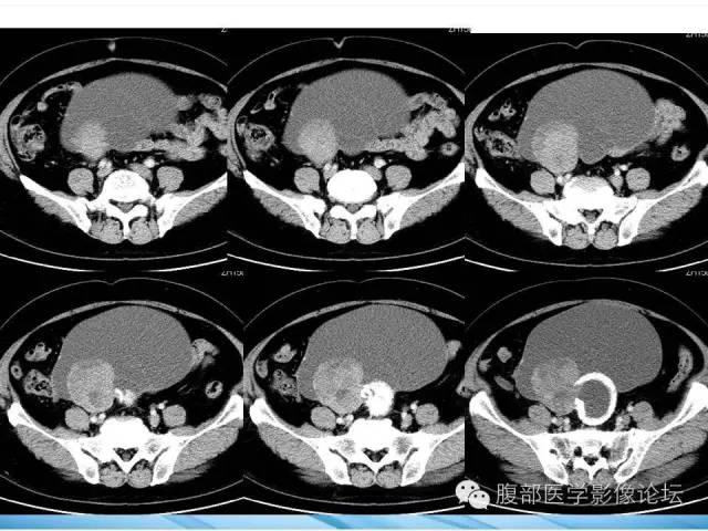 【病例】卵巢透明细胞腺癌1例CT影像表现