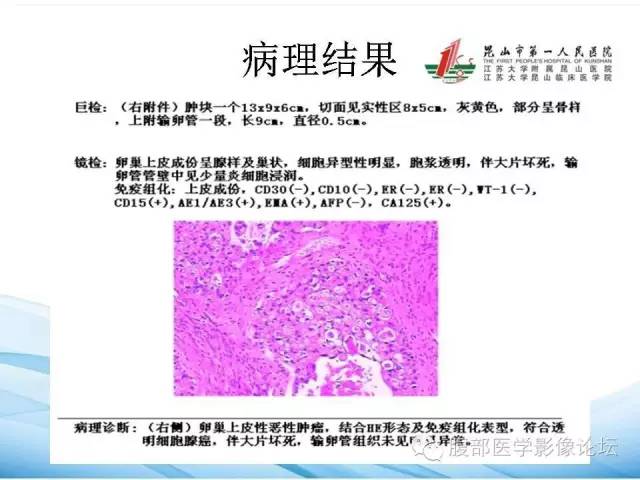 【病例】卵巢透明细胞腺癌1例CT影像表现