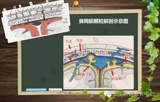 【PPT】蛛网膜颗粒的影像学表现
