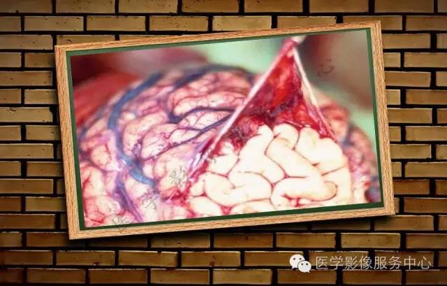 【PPT】蛛网膜颗粒的影像学表现