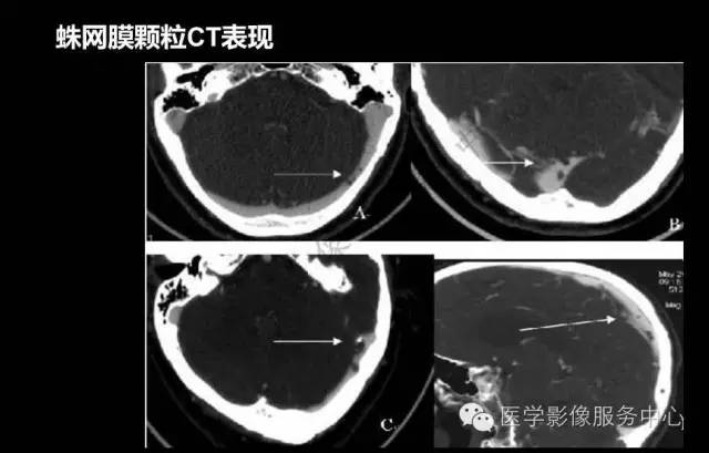 【PPT】蛛网膜颗粒的影像学表现