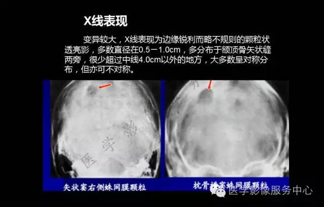【PPT】蛛网膜颗粒的影像学表现