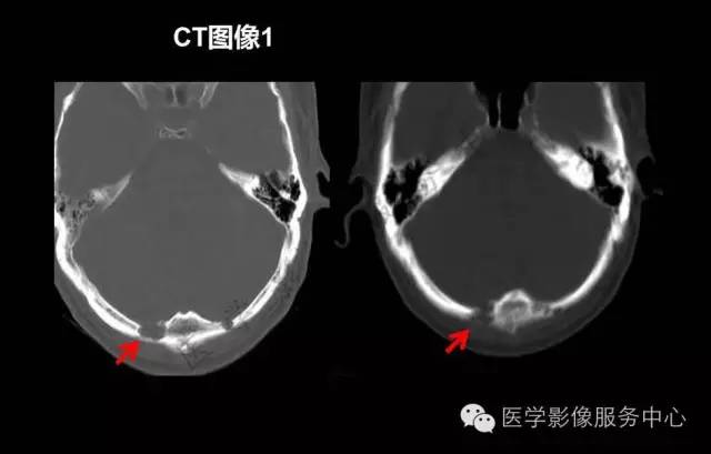【PPT】蛛网膜颗粒的影像学表现