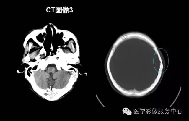 【PPT】蛛网膜颗粒的影像学表现