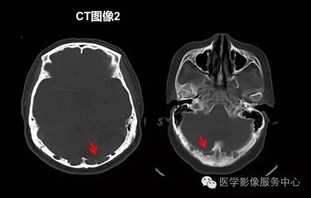 【PPT】蛛网膜颗粒的影像学表现