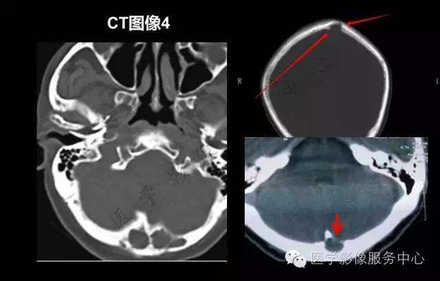 【PPT】蛛网膜颗粒的影像学表现