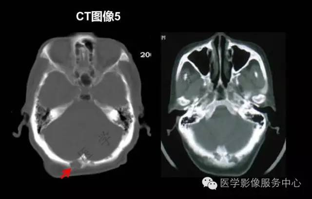 【PPT】蛛网膜颗粒的影像学表现