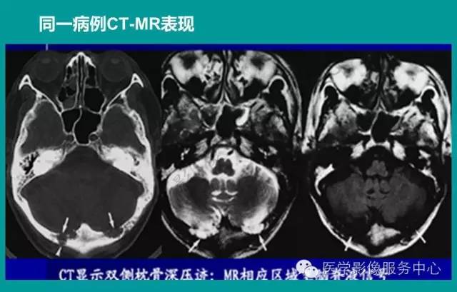 【PPT】蛛网膜颗粒的影像学表现