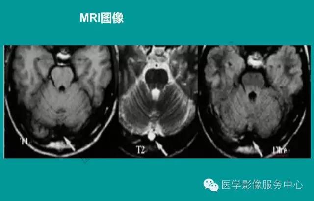 【PPT】蛛网膜颗粒的影像学表现