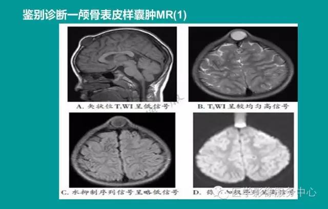 【PPT】蛛网膜颗粒的影像学表现