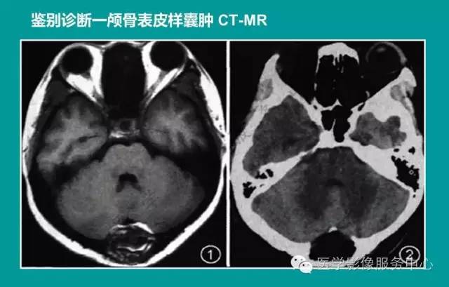 【PPT】蛛网膜颗粒的影像学表现
