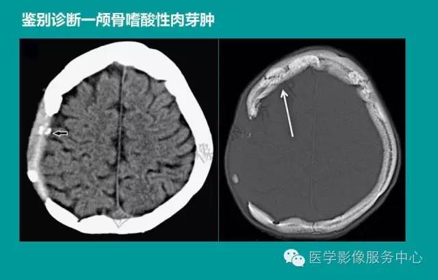 【PPT】蛛网膜颗粒的影像学表现