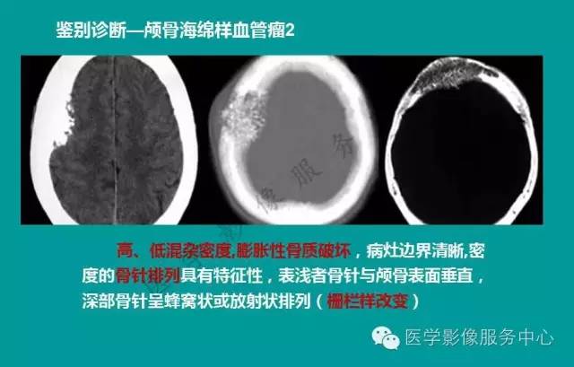 【PPT】蛛网膜颗粒的影像学表现