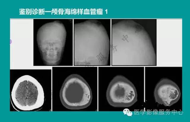 【PPT】蛛网膜颗粒的影像学表现