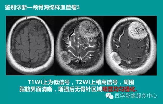 【PPT】蛛网膜颗粒的影像学表现