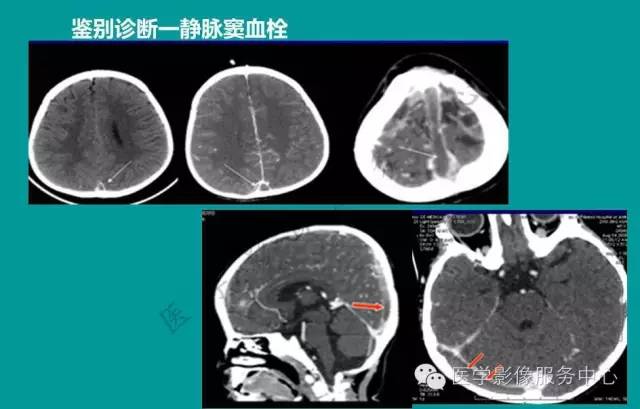 【PPT】蛛网膜颗粒的影像学表现