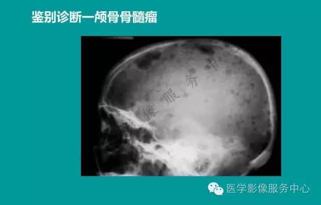 【PPT】蛛网膜颗粒的影像学表现