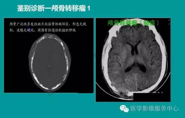 【PPT】蛛网膜颗粒的影像学表现