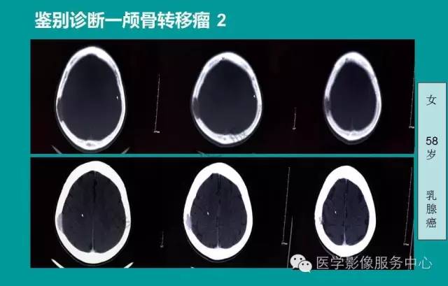 【PPT】蛛网膜颗粒的影像学表现