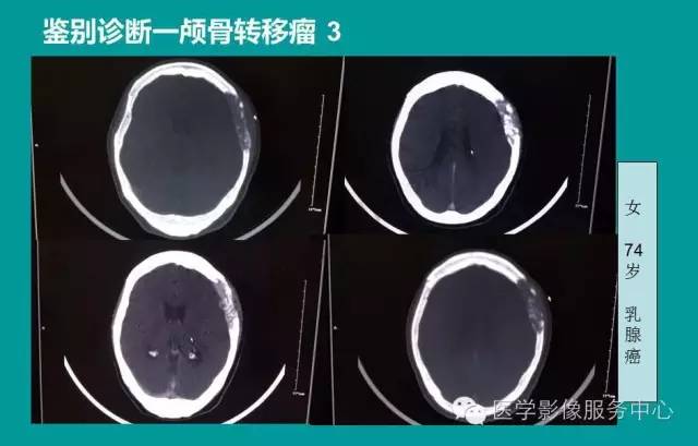 【PPT】蛛网膜颗粒的影像学表现