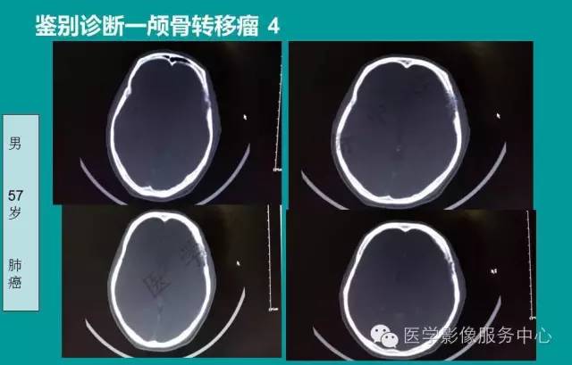 【PPT】蛛网膜颗粒的影像学表现