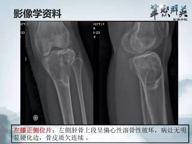 【病例】胫骨高分化骨肉瘤1例X线CT及MR影像表现