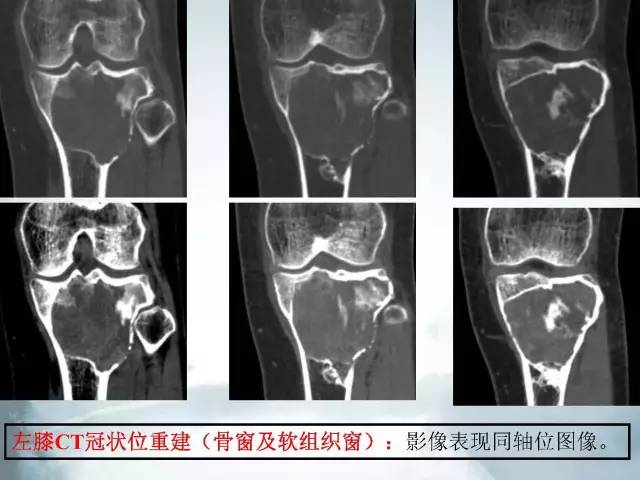 【病例】胫骨高分化骨肉瘤1例X线CT及MR影像表现