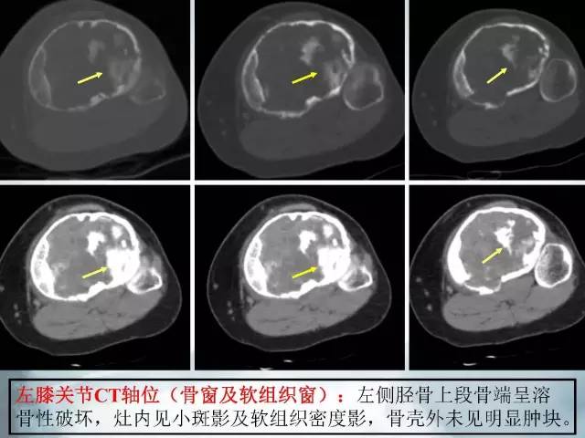 【病例】胫骨高分化骨肉瘤1例X线CT及MR影像表现