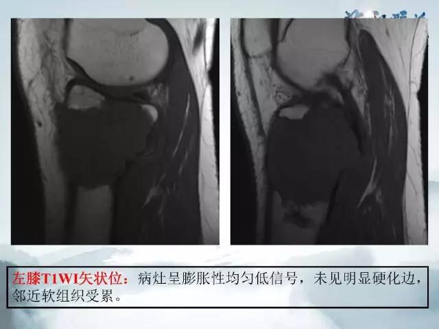 【病例】胫骨高分化骨肉瘤1例X线CT及MR影像表现