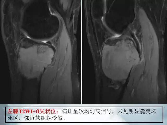 【病例】胫骨高分化骨肉瘤1例X线CT及MR影像表现