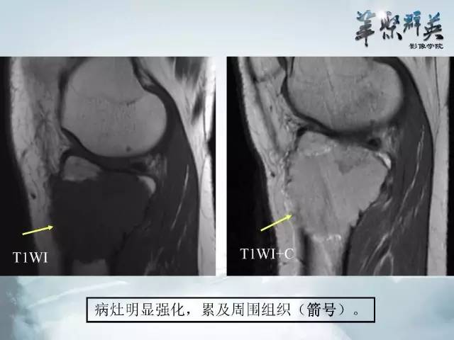 【病例】胫骨高分化骨肉瘤1例X线CT及MR影像表现