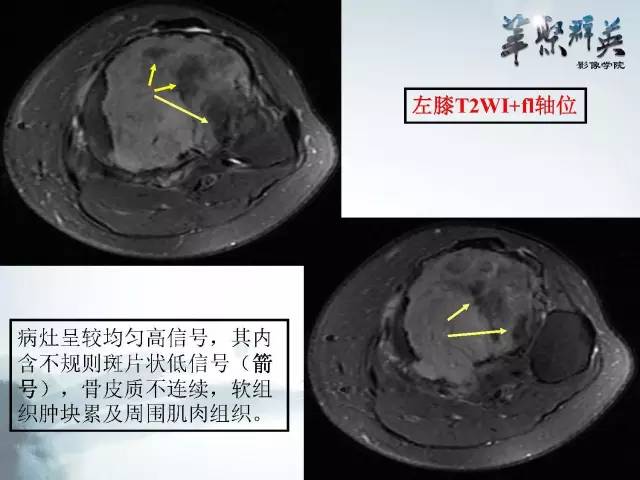 【病例】胫骨高分化骨肉瘤1例X线CT及MR影像表现