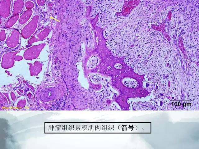 【病例】胫骨高分化骨肉瘤1例X线CT及MR影像表现