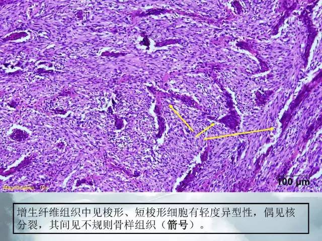 【病例】胫骨高分化骨肉瘤1例X线CT及MR影像表现