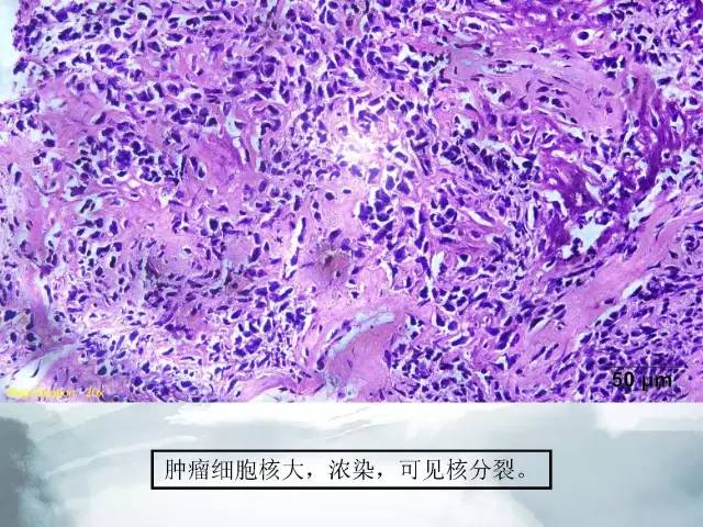 【病例】胫骨高分化骨肉瘤1例X线CT及MR影像表现