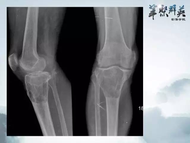 【病例】胫骨高分化骨肉瘤1例X线CT及MR影像表现
