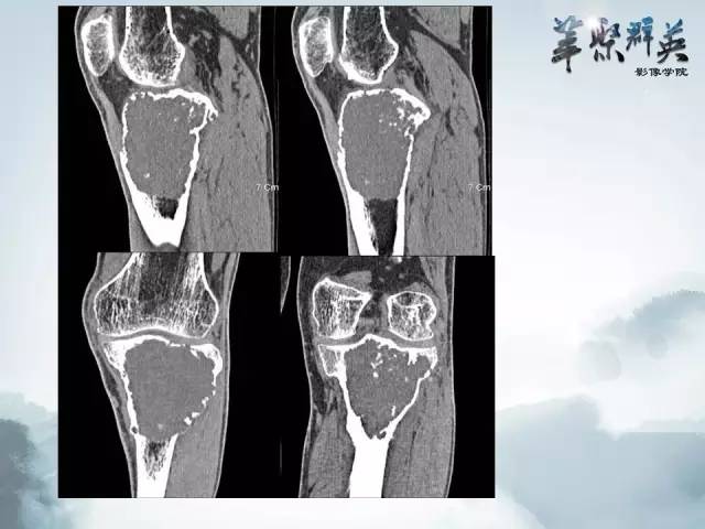 【病例】胫骨高分化骨肉瘤1例X线CT及MR影像表现
